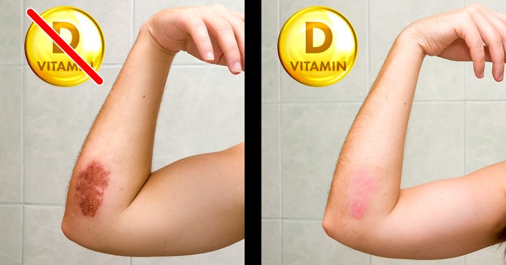 8 dấu hiệu của cơ thể nhắc nhở bạn cần bổ sung ngay vitamin D ảnh 6 8 dấu hiệu của cơ thể nhắc nhở bạn cần bổ sung ngay vitamin D ảnh 6