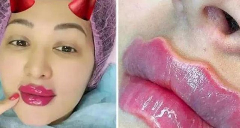 Đẹp thì mỗi người có quan niệm khác nhau nhưng nguy cơ mà “Devil's Lips” gây ra cho sức khỏe là có thật.