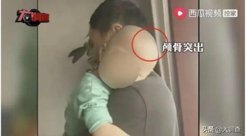 Trẻ em sau khi uống "Bội An Mẫn" có đầu to dị thường (Ảnh: Toutiao). Trẻ em sau khi uống "Bội An Mẫn" có đầu to dị thường (Ảnh: Toutiao).
