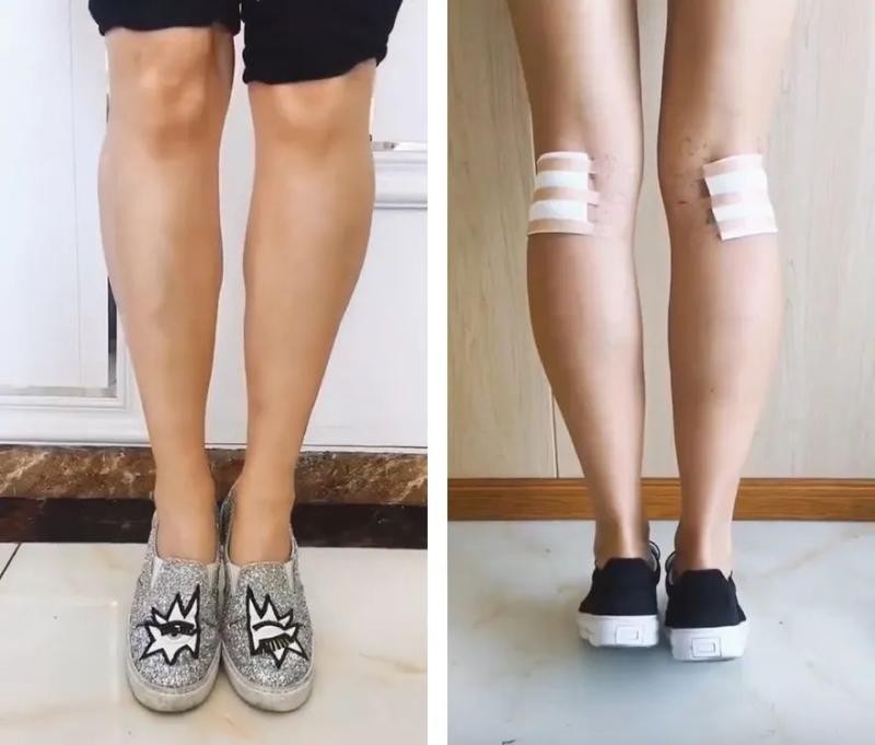 Chân của một cô gái Australia khi đã được phẫu thuật nội soi Phong tỏa bắp chân (Ảnh: The Paper).