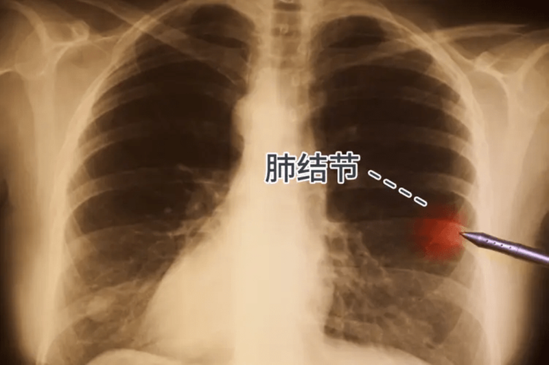 Nhiều người trưởng thành có các hạch ở phổi (Ảnh: Singtao). Noi chung nguoi truong thanh deu co ket hach phoi.png