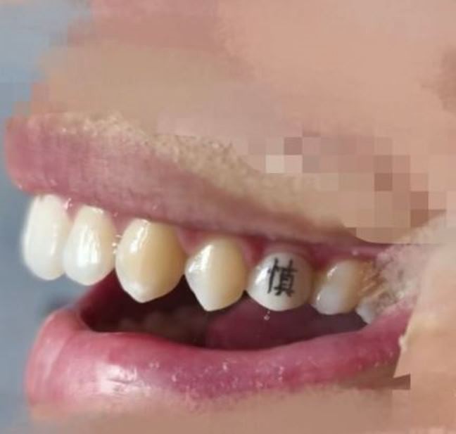 Hàm răng với chữ "Thận" được một cư dân mạng đăng ảnh khoe. Ảnh: QQnews. Chu Than.jpg