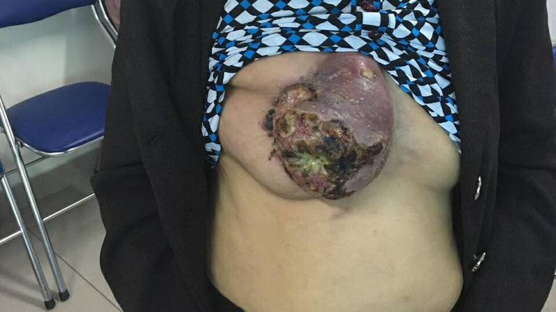 Bệnh nhân ung thư vú tự đắp lá "điều trị" và hậu quả phải cắt bỏ toàn bộ Bệnh nhân ung thư vú tự đắp lá