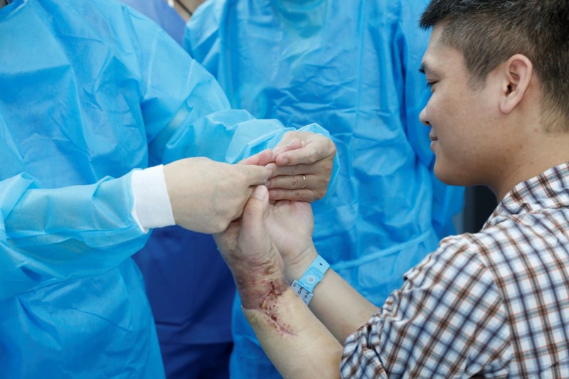 Bàn tay được ghép sau một tháng đã cử động được khá bình thường Bàn tay được ghép sau một tháng đã cử động được khá bình thường