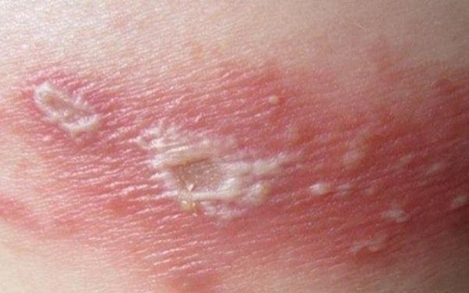 Bệnh zona có thể ảnh hưởng nghiêm trọng đến sức khỏe Bệnh zona thần kinh.jpg