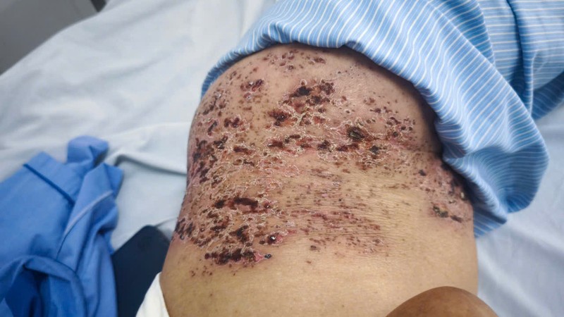 Tổn thương do zona thần kinh z6573725309904_4555c115e9a13536aed7d4617664c928.jpg