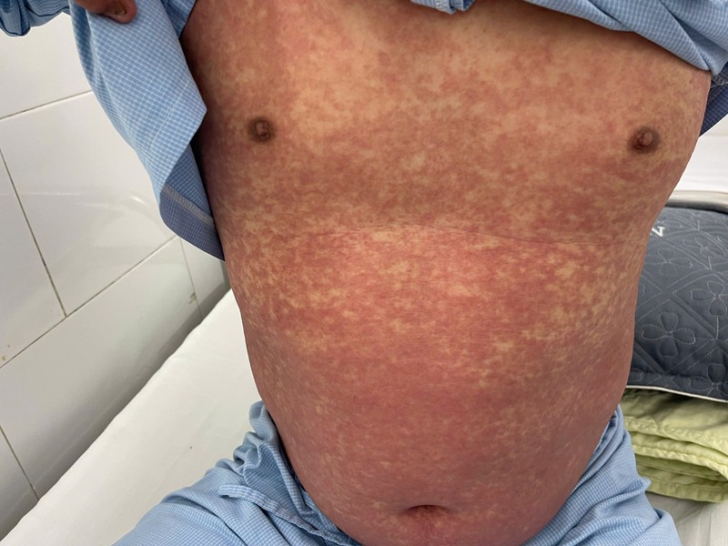 Bệnh nhân dị ứng thuốc nặng do Phenylbutazone điều trị tại Bệnh viện Bạch Mai 1.jpg