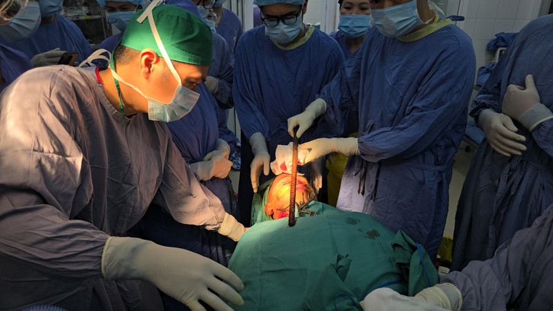 Ca mổ nghẹt thở lấy thanh sắt ra khỏi đâù - mặt nạn nhân 16 tuổi 1.JPEG