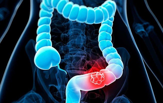 Trong khi có thể đóng một vai trò trong việc thúc đẩy xu hướng đáng báo động của ung thư đại trực tràng, béo phì có lẽ không phải là toàn bộ lời giải thích. Trong khi có thể đóng một vai trò trong việc thúc đẩy xu hướng đáng báo động của ung thư đại trực tràng, béo phì có lẽ không phải là toàn bộ lời giải thích.