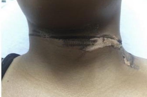 Cô gái bị bỏng cấp độ 2 khi dùng cáp sạc đểu Cô gái bị bỏng cấp độ 2 khi dùng cáp sạc đểu