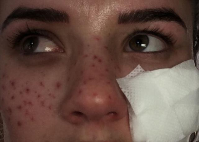 Whitfield học theo mẹo làm đẹp da bằng cách đâm kim châm cứu lên mặt.