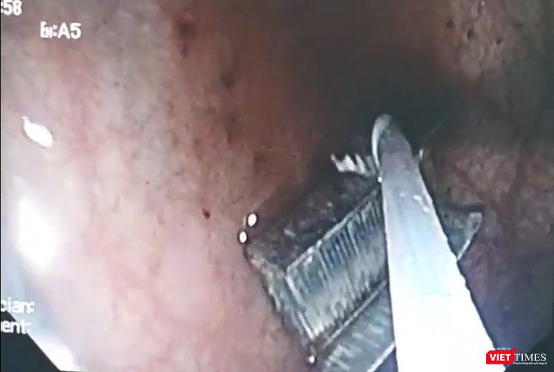 Camera nội soi ghi lại hình ảnh gắp dị vật là vĩ ghim bấm bên trong đường thở của trẻ Camera nội soi ghi lại hình ảnh gắp dị vật là vĩ ghim bấm bên trong đường thở của trẻ