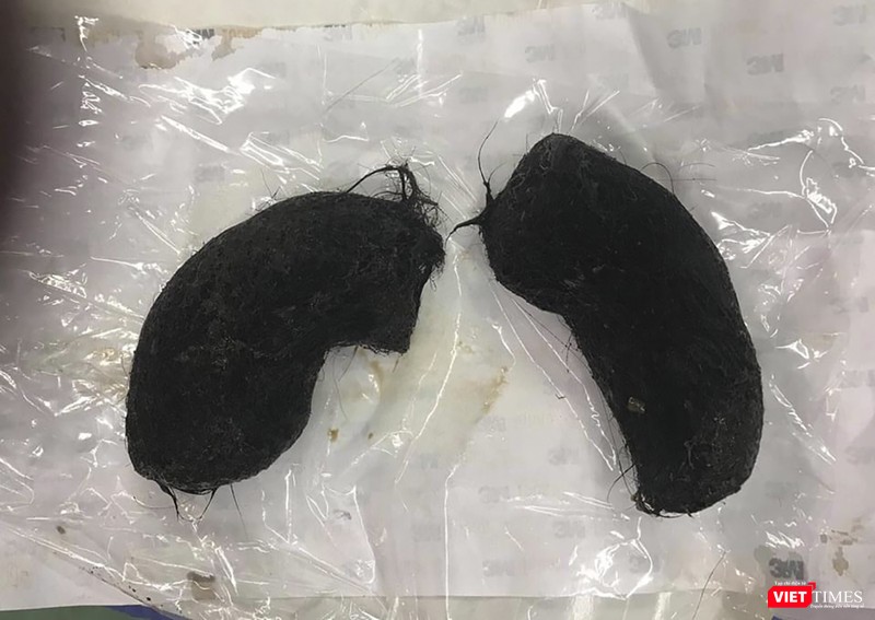 Búi tóc được lấy ra từ dạ dày của bệnh nhi 13 tuổi nhập viện trong tình trạng nguy kịch Búi tóc được lấy ra từ dạ dày của bệnh nhi 13 tuổi nhập viện trong tình trạng nguy kịch