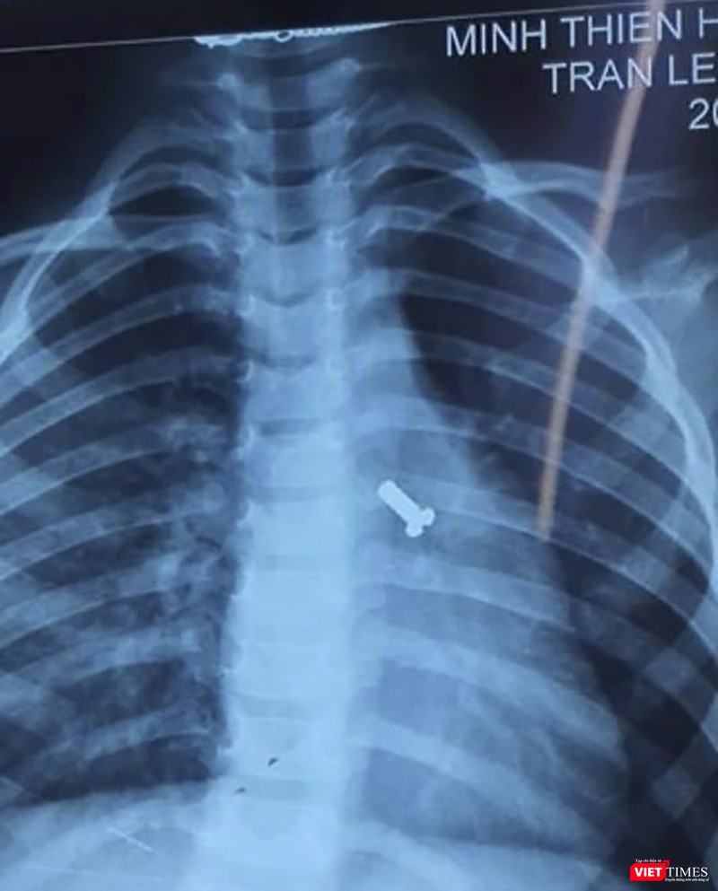 Phim X-quang đinh vít nằm ở đường thở của trẻ Phim X-quang đinh vít nằm ở đường thở của trẻ