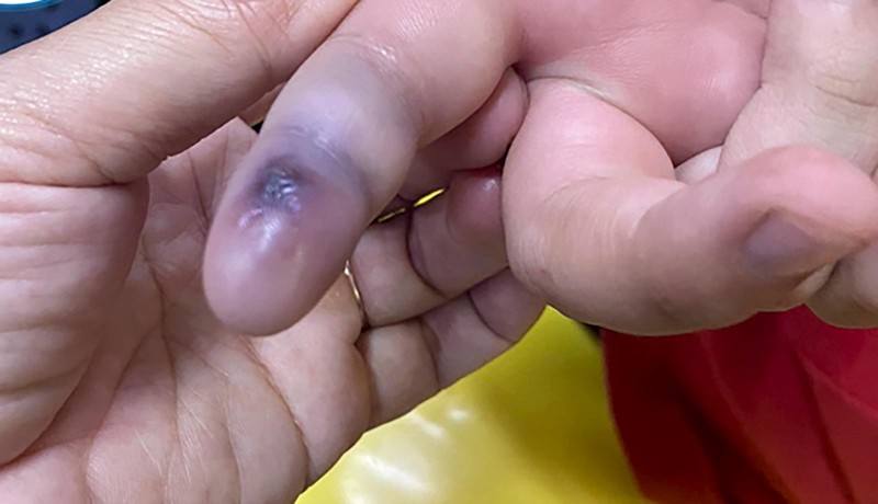 Vết cắn do rắn lục đuôi đỏ để lại (ảnh bệnh viện cung cấp)