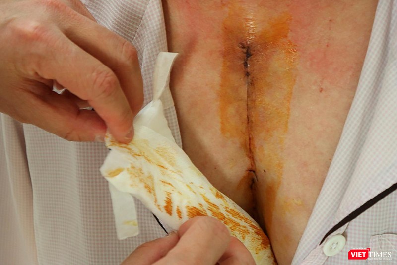 Vết mổ của bệnh nhân đã dần ổn định Vết mổ của bệnh nhân đã dần ổn định