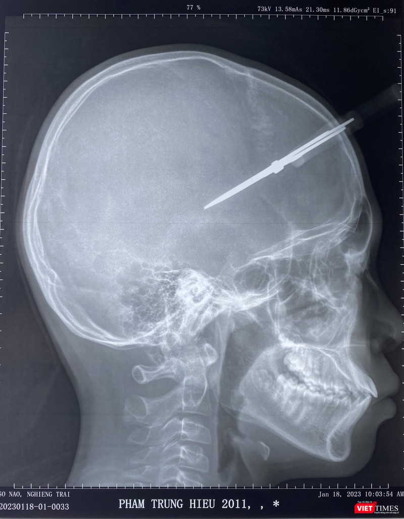 Phim chụp hộp sọ bệnh nhân và chiếc kéo cắm vào thái dương Phim chụp hộp sọ bệnh nhân và chiếc kéo cắm vào thái dương