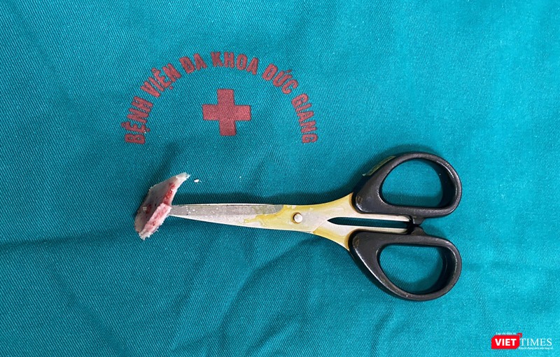 Mảnh sọ cùng chiếc kéo đâm thủng được lấy ra sau ca phẫu thuật Mảnh sọ cùng chiếc kéo đâm thủng được lấy ra sau ca phẫu thuật