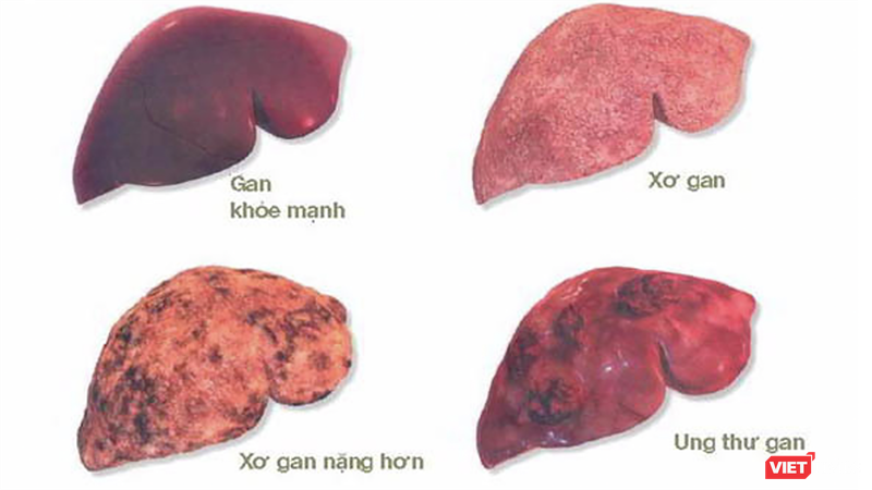 Hình ảnh tình trạng sức khoẻ của gan (ảnh BVCC) vt_ung thu gan 2.png