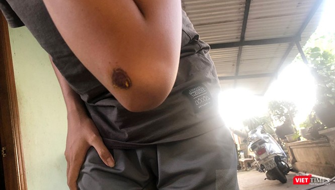 Nạn nhân bị thương. Nạn nhân bị thương.