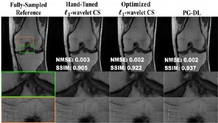 Đại học Minnesota Twin Cities đưa ra giải pháp nâng cao hiệu suất cho phép chụp MRI nhanh hơn không sử dụng các phương pháp học sâu mới hơn. Ảnh: Phòng thí nghiệm xử lý hình ảnh và hình ảnh y tế thông minh, Đại học Minnesota