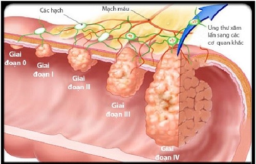 Các giai đoạn phát triển ung thư phổi. Ảnh: Phụ nữ Online Các giai đoạn phát triển ung thư phổi. Ảnh: Phụ nữ Online
