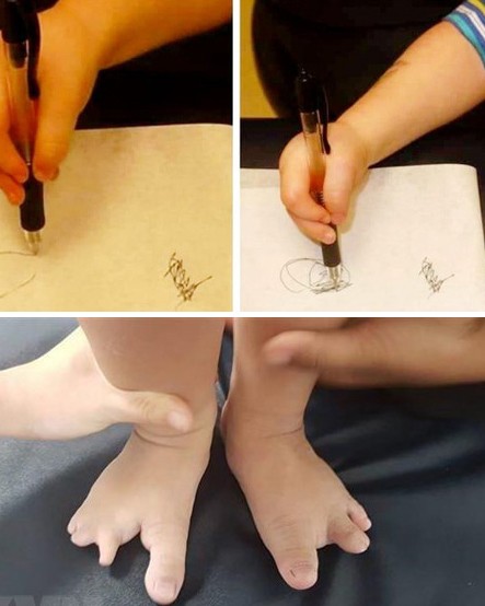 Hội chứng tay chân càng cua rất hiếm gặp Hội chứng tay chân càng cua rất hiếm gặp