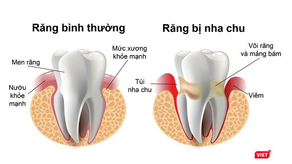 Mất răng do bệnh nha chu (Ảnh: bác sĩ tại nha khoa Westcoast cung cấp) Mất răng do bệnh nha chu (Ảnh: cung cấp)