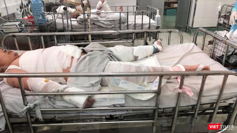 Cả ba cha con cùng bị bỏng rất nặng sau vụ châm lửa đốt nhà (Ảnh: MT)