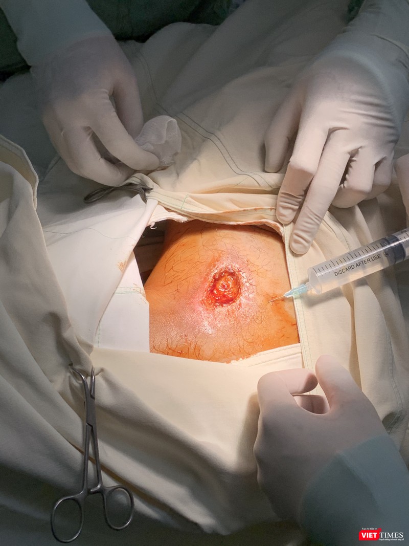 Ảnh chụp vết thương của bệnh nhân do tự thử máy X-quang trước đó, nhập viện vào BV Quốc tế Minh Anh và đang được điều trị (Nguồn: BVCC)