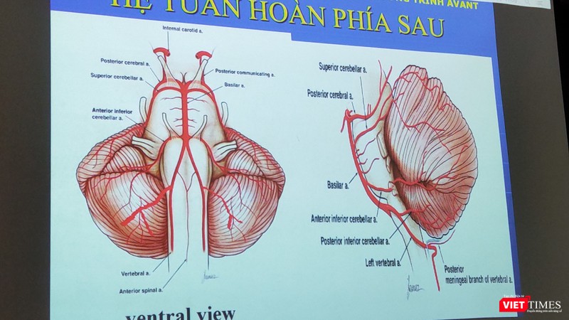 BS Nguyễn Bá Thắng – Trưởng khoa Thần kinh, BV Đại học Y Dược TP.HCM nhấn mạnh chẩn đoán định khu tổn thương rất quan trọng (Ảnh: Hoà Bình) BS Nguyễn Bá Thắng – Trưởng khoa Thần kinh, BV Đại học Y Dược TP.HCM nhấn mạnh chẩn đoán định khu tổn thương rất quan trọng (Ảnh: Hoà Bình)
