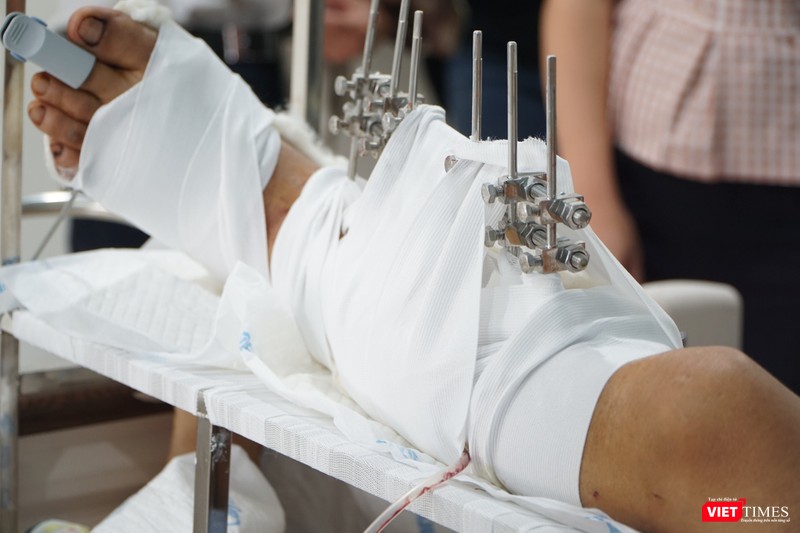 Nhờ cấp cứu kịp thời, BS điều trị tại BV Quân Y 175 đã giữ được chân bị chém đứt lìa của bệnh nhân (Ảnh: BVCC) Nhờ cấp cứu kịp thời, BS điều trị tại BV Quân Y 175 đã giữ được chân bị chém đứt lìa của bệnh nhân (Ảnh: BVCC)