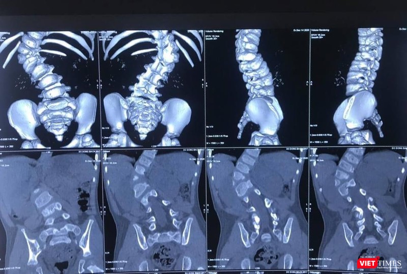 Hình ảnh X quang ca cong vẹo cột sống của bệnh nhi 3 tuổi (BVCC)