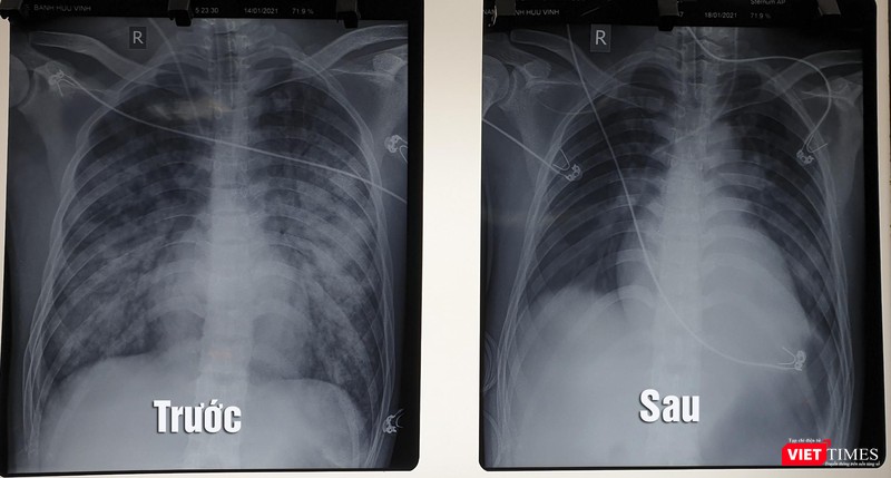 Hình ảnh X quang phổi của bệnh nhân trước và sau khi điều trị bằng kỹ thuật ECMO (Ảnh: BVCC) Hình ảnh X quang phổi của bệnh nhân trước và sau khi điều trị bằng kỹ thuật ECMO (Ảnh: BVCC)