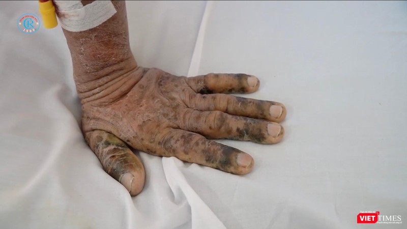 Bàn tay của một bệnh nhân nhiễm độc thuốc nam