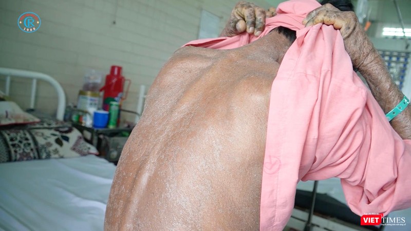 Một bệnh nhân nhiễm độc thuốc nam với triệu chứng khắp người