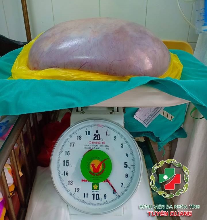 Khối u nặng 8 kg cắt ra từ bụng của chị N. Khối u nặng 8 kg cắt ra từ bụng của chị N.