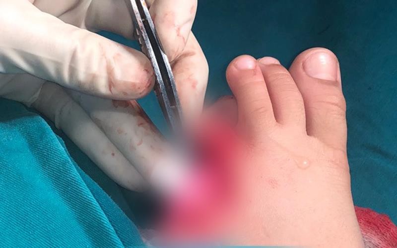 Bàn chân bị thương của bé H. Bàn chân bị thương của bé H.