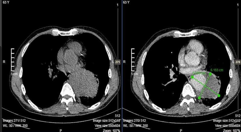 Ảnh chụp CT cho thấy động mạch của anh Q. bị phình Ảnh chụp CT cho thấy động mạch của anh Q. bị phình