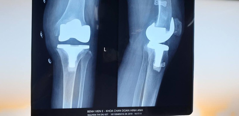 Ảnh chụp Xquang khớp gối của bệnh nhân