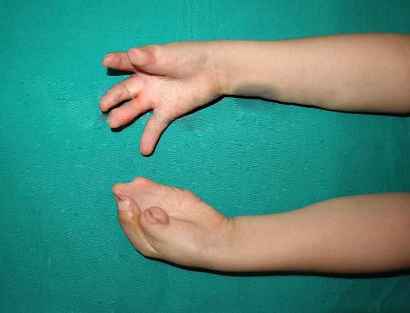 Bàn tay trái của T. bị dị tật dính liền 5 ngón Bàn tay trái của T. bị dị tật dính liền 5 ngón