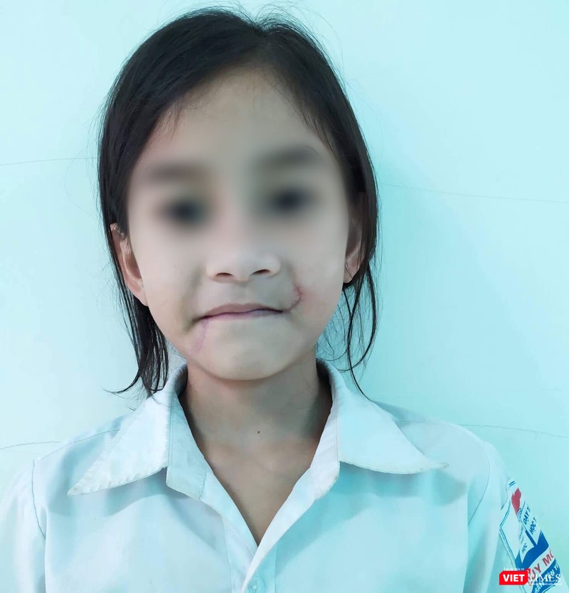 Gương mặt bé T. lành lặn sau khi điều trị Gương mặt bé T. lành lặn sau khi điều trị