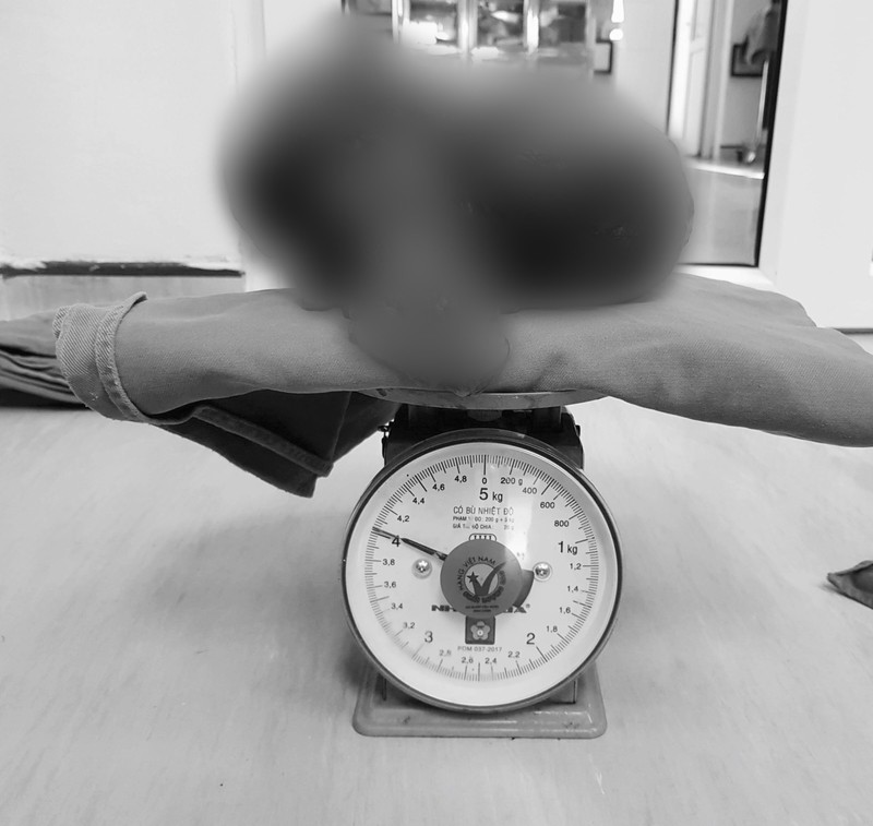 Khối u nặng gần 4kg lấy ra từ bụng bệnh nhân Khối u nặng gần 4kg lấy ra từ bụng bệnh nhân