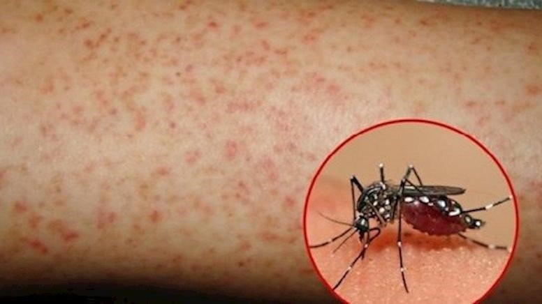 Quản lý thực trạng sử dụng kháng sinh bừa bãi, bài toán cho ngành bệnh truyền nhiễm	 ảnh 4 Những vật dụng trong nhà thân thuộc nhưng chứa bọ gậy gây sốt xuất huyết