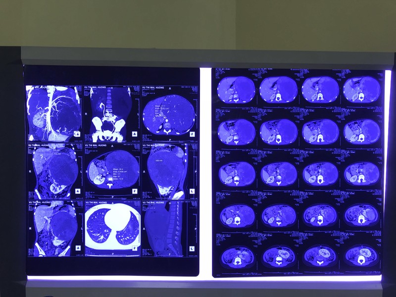 Phim chụp X-quang của em H. Phim chụp X-quang của em H.