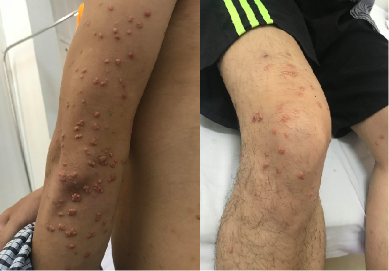 Các nốt sần đặc nhân vàng nổi dày đặc trên tay và chân của anh K. Các nốt sần đặc nhân vàng nổi dày đặc trên tay và chân của anh K.