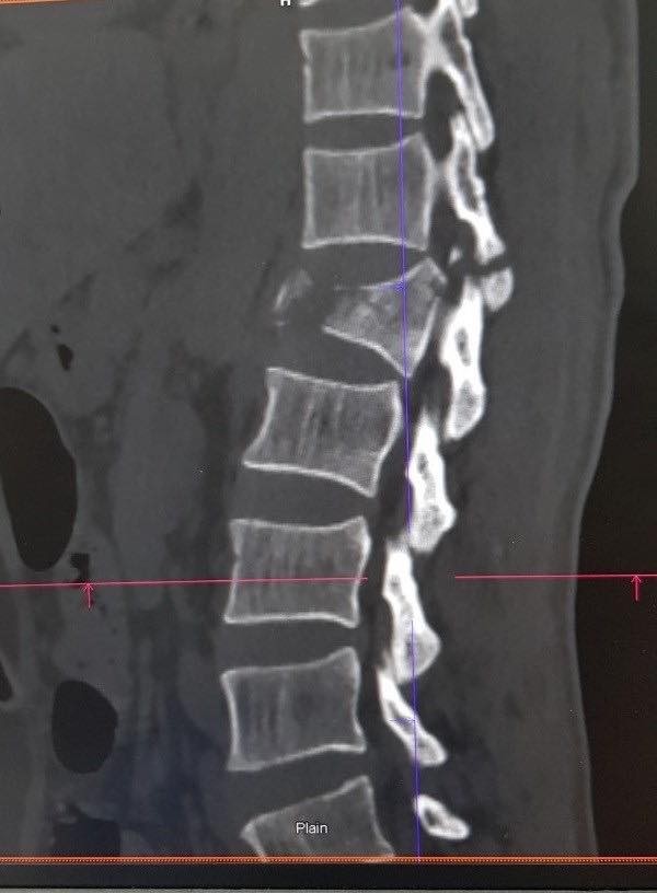 Ảnh minh họa đoạn đốt sống L1 trên cơ thể