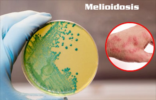 Ảnh minh họa bệnh Melioidosis (hay còn gọi là bệnh Whitmore).