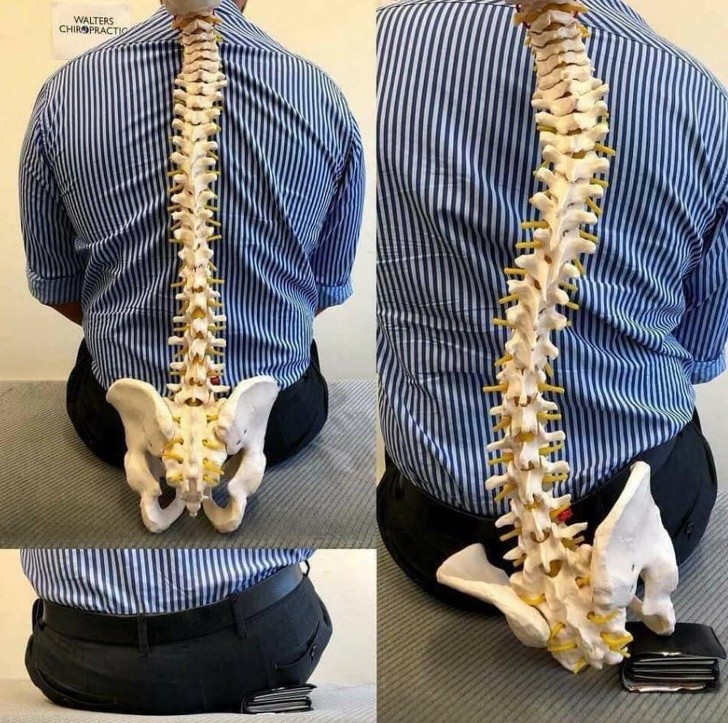 Cột sống bị cong, vẹo vì phải ngồi sai tư thế khi có chiếc ví dày cộm ở túi sau. Cột sống bị cong, vẹo vì phải ngồi sai tư thế khi có chiếc ví dày cộm ở túi sau.