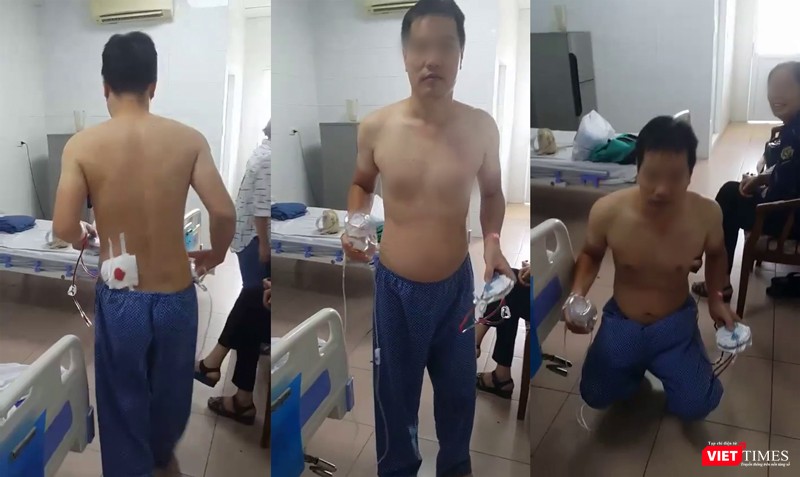 Một bệnh nhân tại Bệnh viện Thanh Nhàn phục hồi sau khi được áp dụng phương pháp phẫu thuật nội soi chữa thoát vị đĩa đệm cột sống qua lỗ liên hợp.